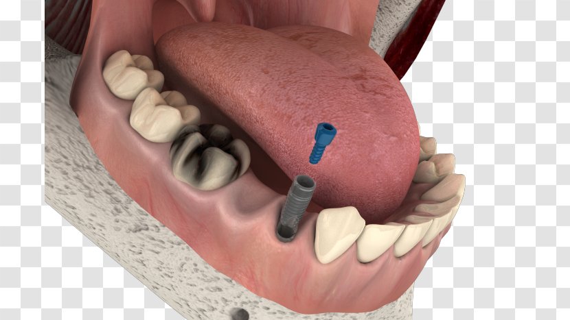 Dental Implant Dentistry Therapy Tooth - Dentures - Implants Bridge Transparent PNG