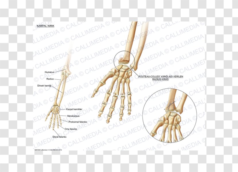Bone Fracture Carpal Bones Wrist Pisiform - Tree Transparent PNG
