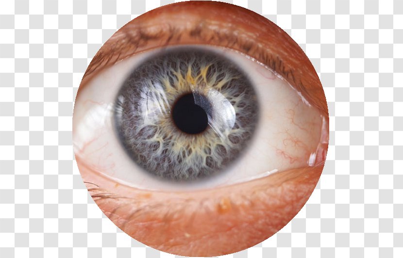 Glaucoma Eye Iridology Health Therapy - Cartoon Transparent PNG