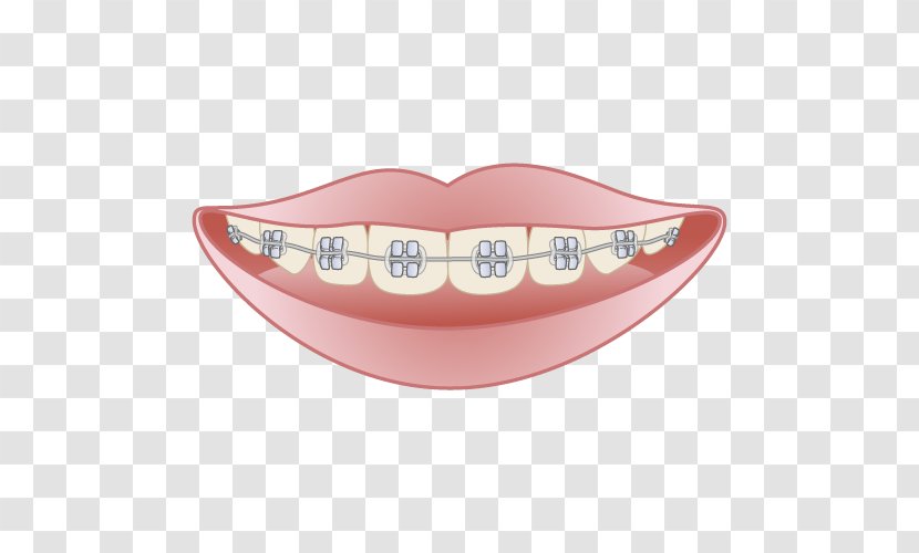 矯正歯科 Dentist Dental Braces Mouthguard Damon System - O Transparent PNG