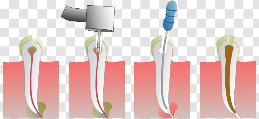 Endodontic Therapy Root Canal Dentist Endodontics Pulp - Tooth Decay - Brush Transparent PNG