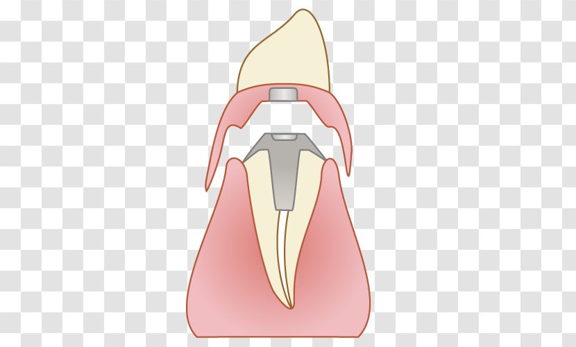 ふれあいファミリー歯科 Dentist Tooth Bridge Dental Implant - Neck Transparent PNG
