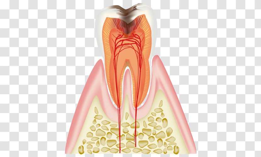 歯科 Dentist Tooth Decay Periodontal Disease - Tree - Dental Caries Transparent PNG