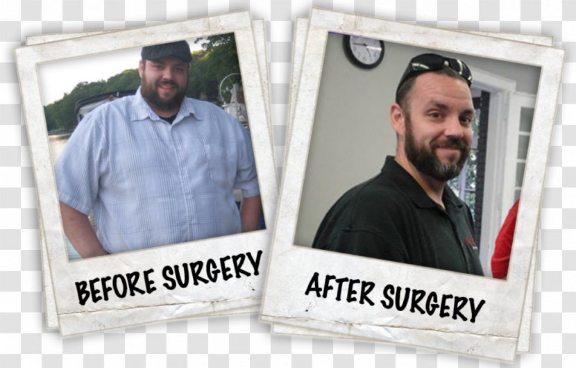 Tom Segura Weight Loss Gastric Bypass Surgery Sleeve Gastrectomy Roux-en-Y Anastomosis - Success Transparent PNG