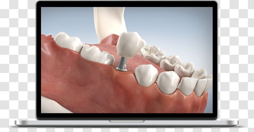 Dental Implant Dentistry Tooth Dentures - Shop Smile Transparent PNG
