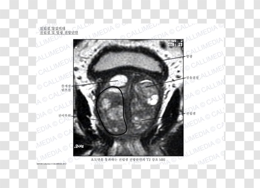 Prostate Urinary Bladder Urology Benign Prostatic Hyperplasia Anatomy - Watercolor - Gland Transparent PNG