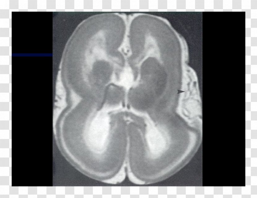 Computed Tomography Brain Radiology Magnetic Resonance Imaging Lääketieteellinen Röntgenkuvaus - Flower Transparent PNG