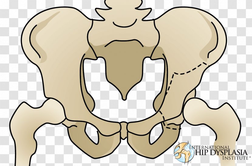 Osteotomy Hip Dysplasia Acetabulum Pelvis - Tree - Pelvic Transparent PNG