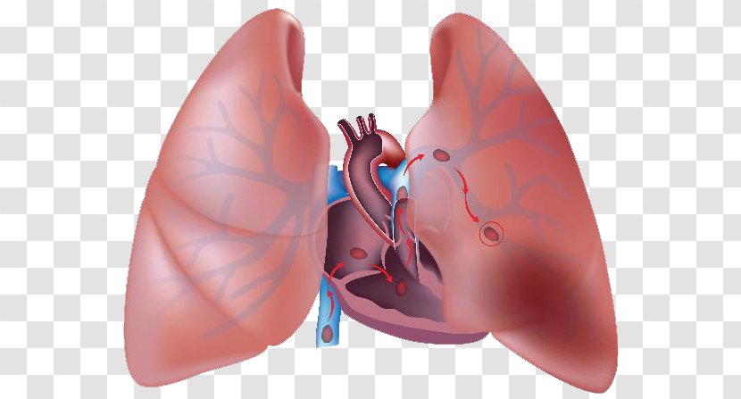 Pulmonary Embolism Thrombus Artery Embolus Lung - Flower - Chronic Obstructive Disease Transparent PNG