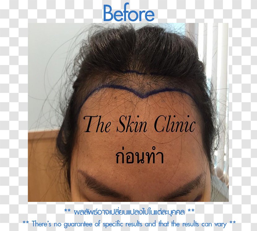 Follicular Unit Extraction Eyebrow Forehead Cheek Nose - Jaw - Mupai Transparent PNG