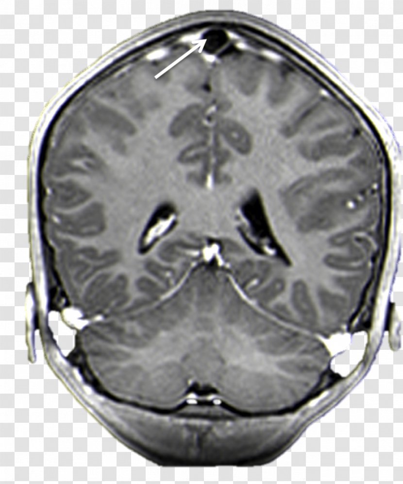 Brain Arachnoid Granulation Superior Sagittal Sinus Magnetic Resonance Imaging Mater - Flower Transparent PNG