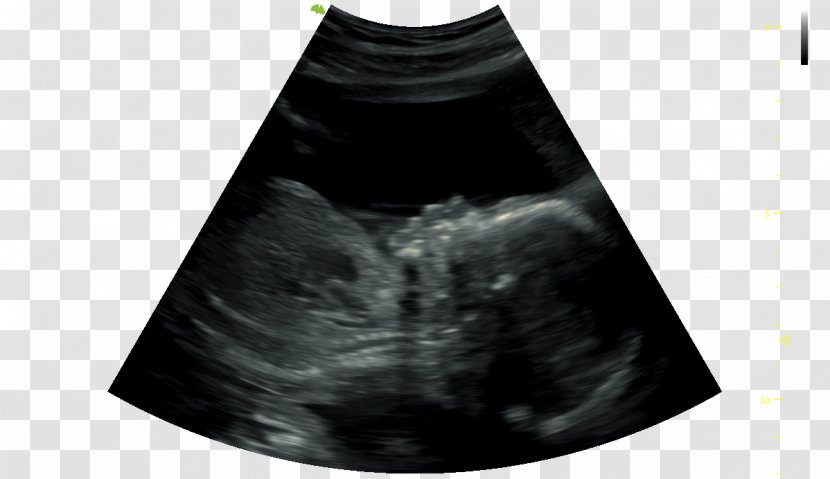 Ultrasound Technology 4D Film Infant Black M - Day To End Obstetric Fistula Transparent PNG