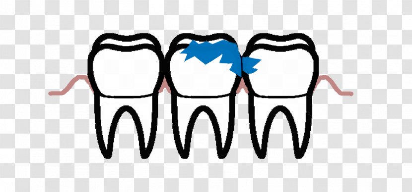 Tooth Decay Periodontal Disease Pulp Endodontics - Heart Transparent PNG