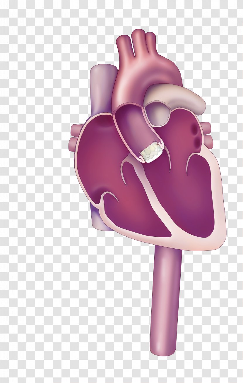 Percutaneous Aortic Valve Replacement Valvular Stenosis Heart - Silhouette Transparent PNG