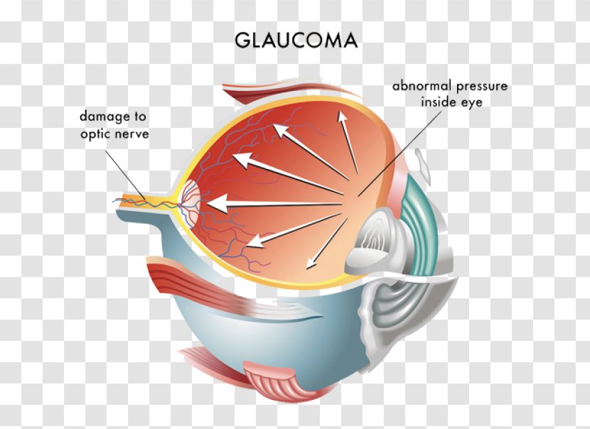 Intraocular Pressure Glaucoma Ocular Hypertension Eye Optic Nerve - Cup Transparent PNG