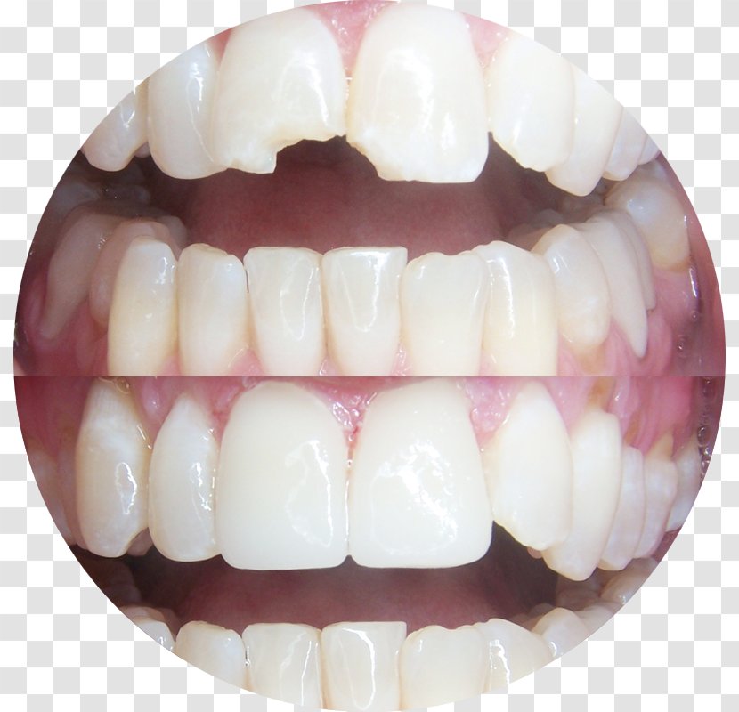 Tooth Dentistry Veneer Crown - Cosmetic Transparent PNG