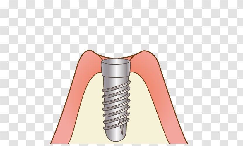 審美歯科 Dentist 矯正歯科 けやき歯科クリニック - Dental Implant - Dentistry Transparent PNG