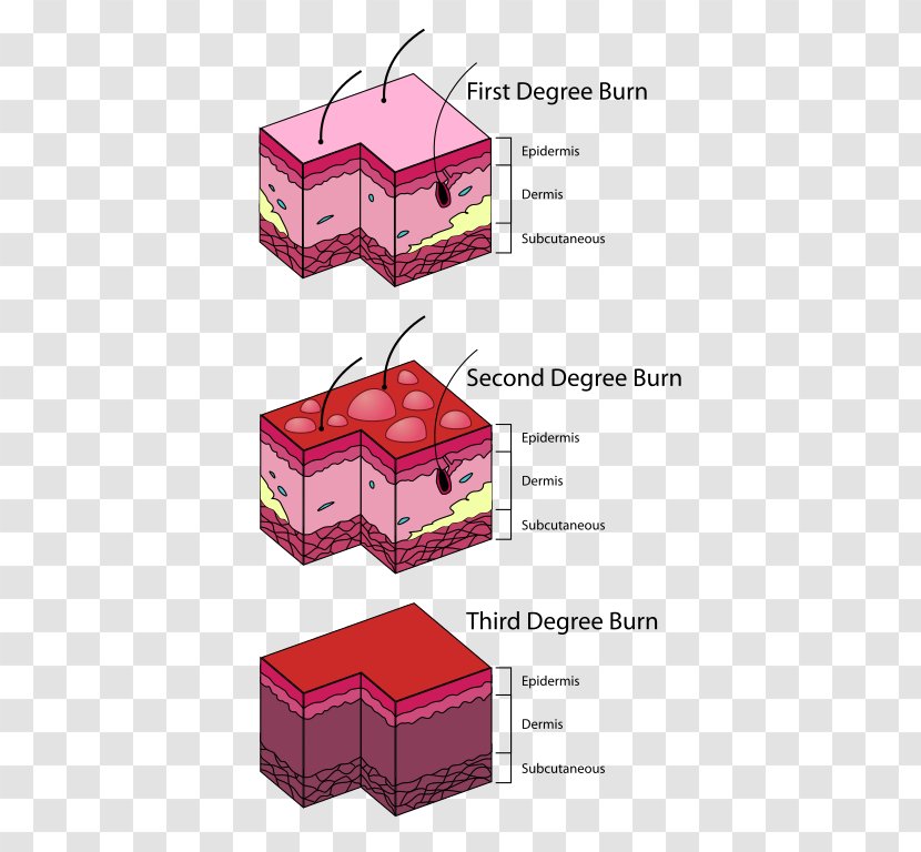 Superficial Thickness Burns Eerstegraads Brandwond First Aid Kits Injury - Box - 2nd Degree Burn Transparent PNG