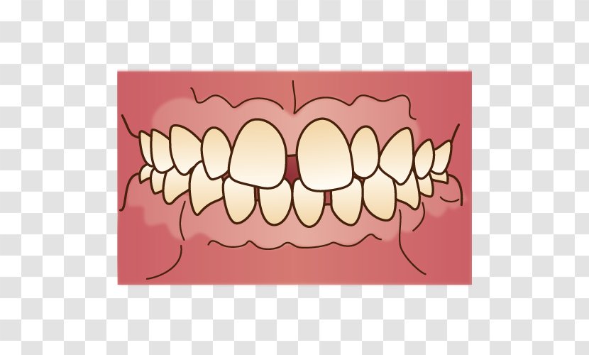 Prognathism Crossbite Malocclusion 歯科 Dentist - Tree - Dental Braces Transparent PNG