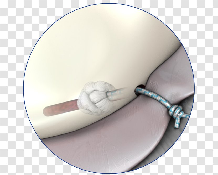 Shoulder Surgery Surgical Suture Medicine Glenoid Labrum - Cartoon Transparent PNG