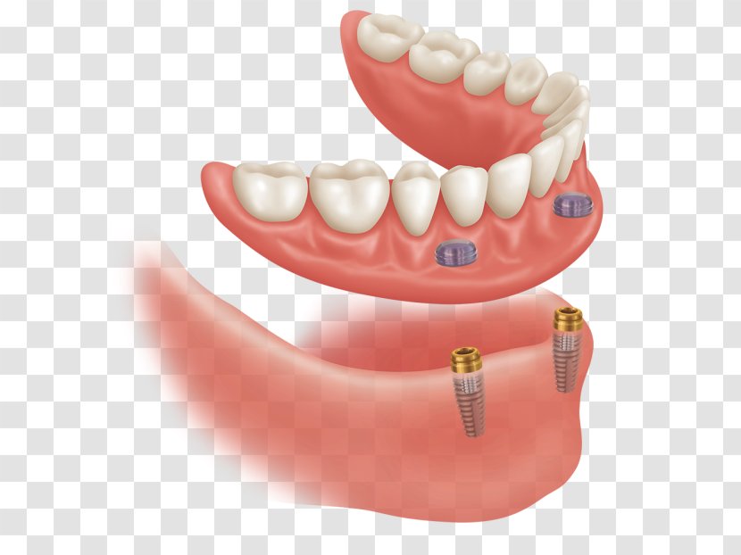 Dental Implant Dentures Dentistry Abutment - Laboratory - Arch Transparent PNG