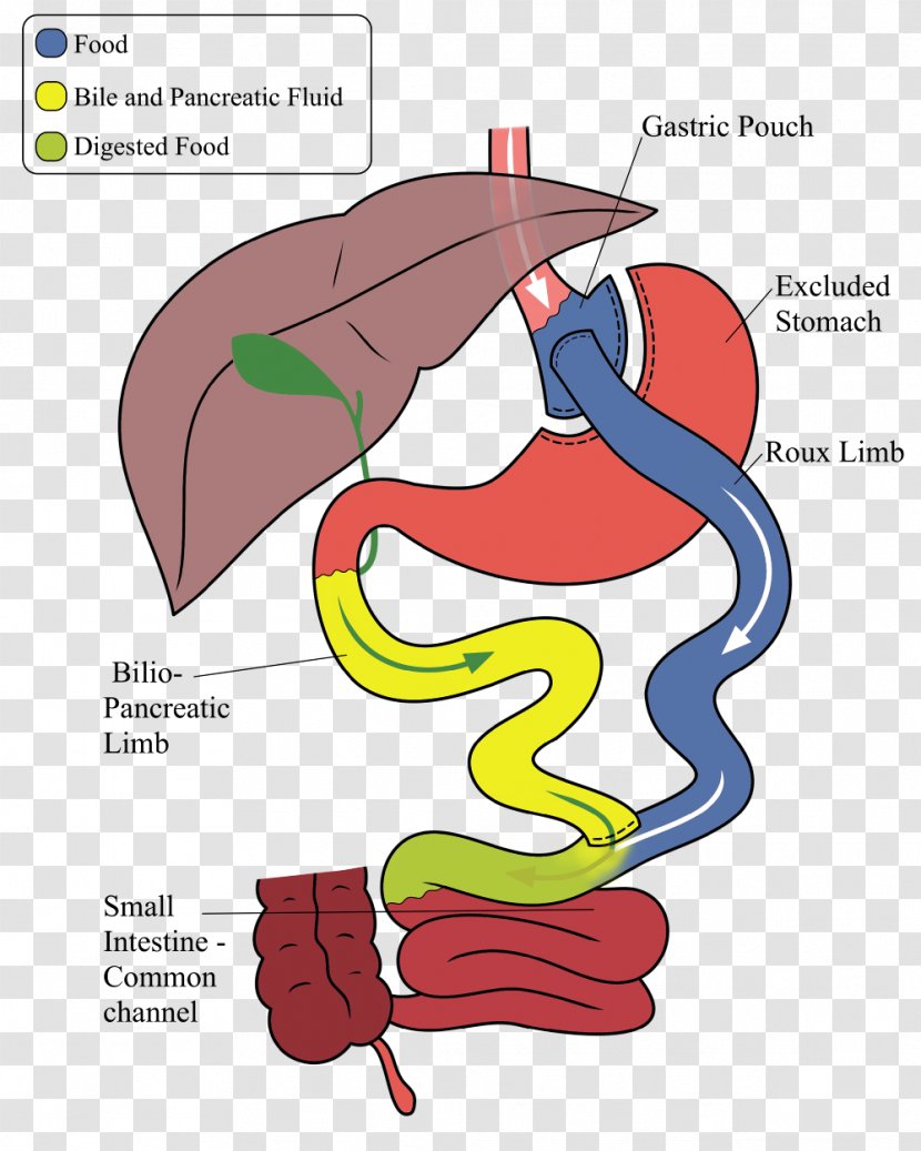 Gastric Bypass Surgery Sleeve Gastrectomy Bariatric Roux-en-Y Anastomosis - Watercolor - Digestive Tract Transparent PNG