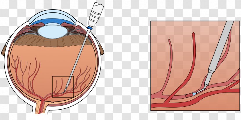 Central Retinal Vein Occlusion Vascular - Watercolor - Anatomy Transparent PNG