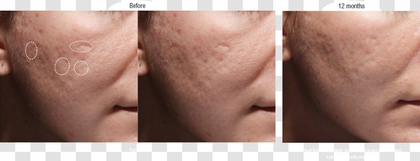 Scar Acne Injectable Filler Wrinkle Dermatology - Watercolor - Scars Transparent PNG