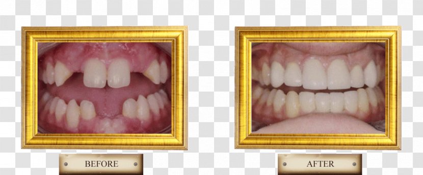 Tooth Picture Frames Health Tongue Beauty.m - Flower - Dental Smile Transparent PNG