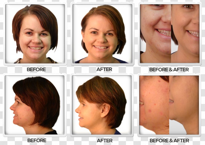 Cheek Nose Acne Lost 118 Chin - Forehead Transparent PNG