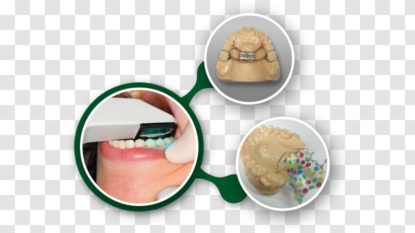 Retainer Orthodontics Laboratory Dental Braces Orthodontic Technology - Splint Transparent PNG