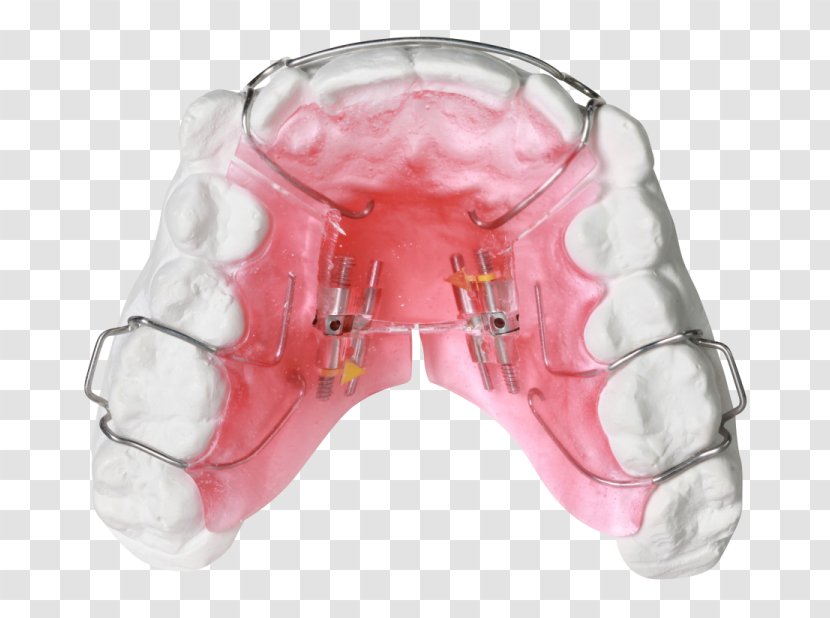 Orthodontics Dental Braces Dentist Retainer Tooth - Therapy - Health Transparent PNG