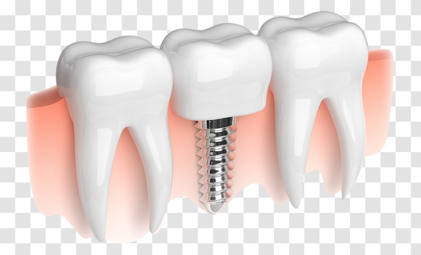 Dental Implant Dentistry Smiles On State Street - Frame - Implants Transparent PNG