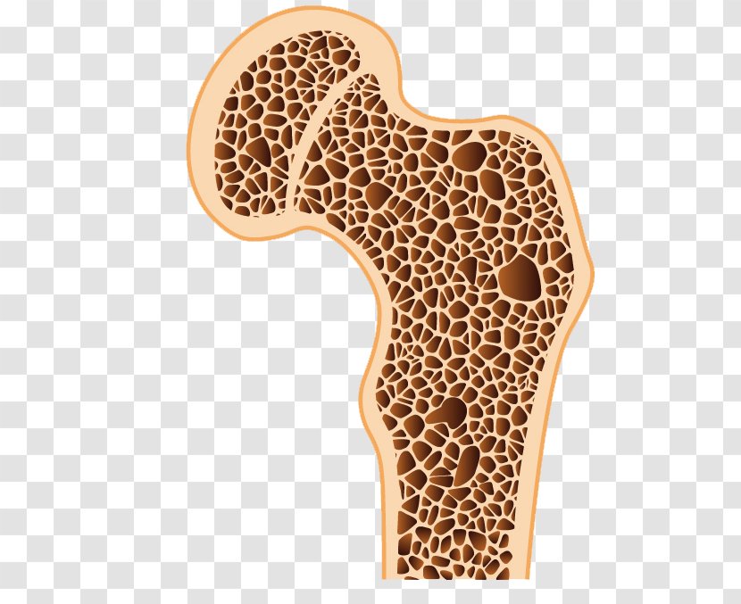 Osteoporosis Bone Density Osteopenia Disease - Bones Transparent PNG