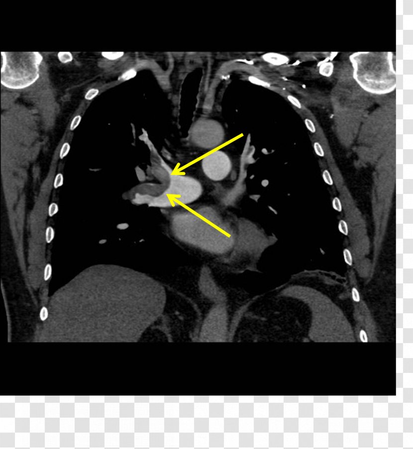 Pulmonary Artery Embolism Embolus CT Angiogram Lung - Silhouette - Cartoon Transparent PNG