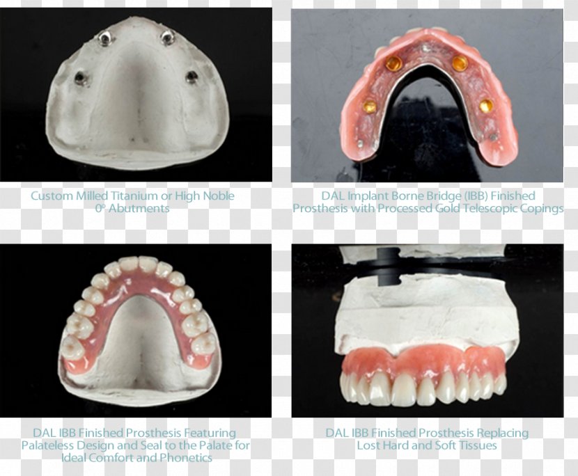 Tooth Dental Implant Bridge Prosthesis Dentures Transparent PNG