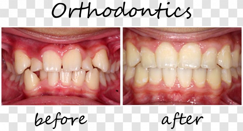Tooth Orthodontics Cosmetic Dentistry Dental Braces - Crown Transparent PNG