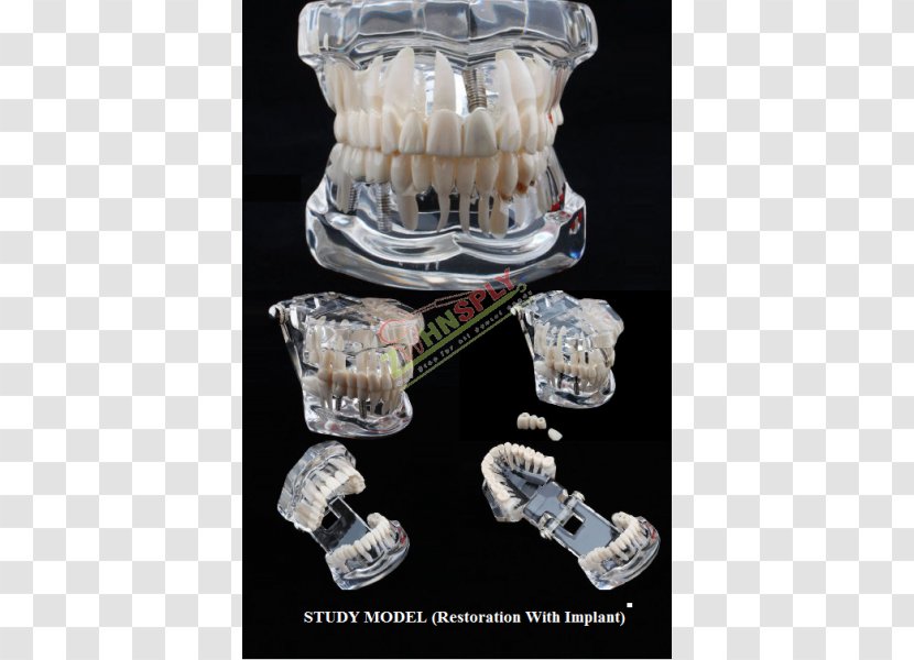 Tooth Decay Jaw Dentistry Bridge - Glass - Study Supplies Transparent PNG