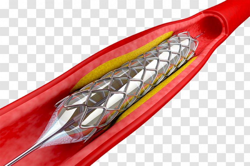 Angioplasty Percutaneous Coronary Intervention Stenting Stent Balloon Catheter - Heart Transparent PNG