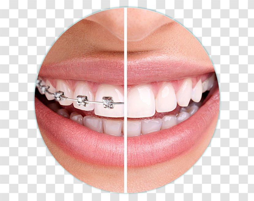 Dentistry Orthodontics Dental Braces Clear Aligners - Chin - Health Transparent PNG