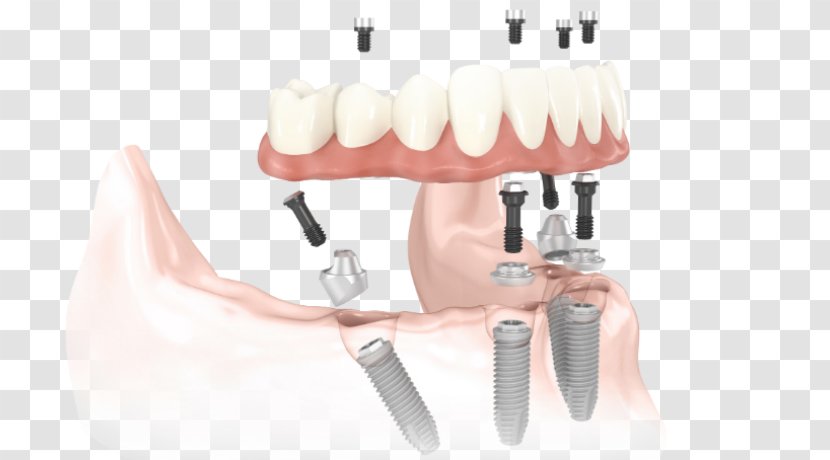 All-on-4 Dental Implant Dentistry Dentures - Bridge Transparent PNG