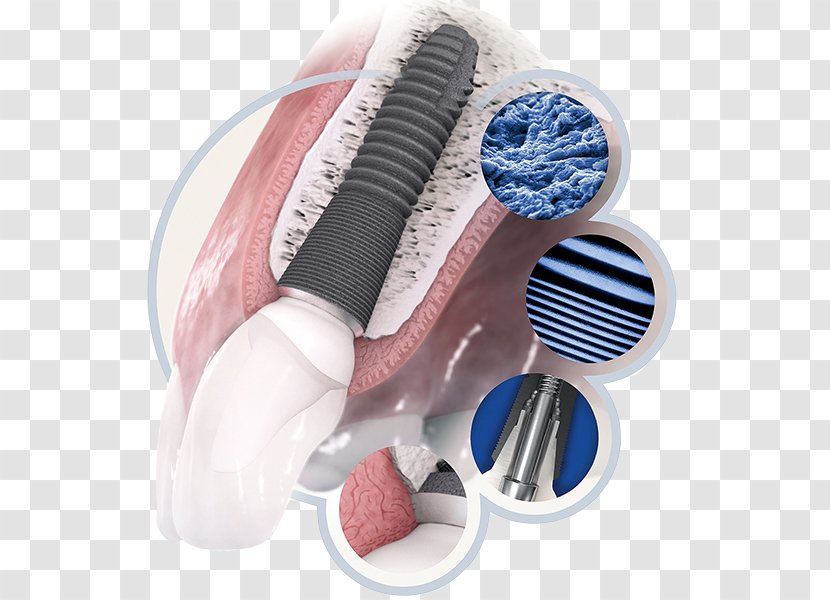 Dental Implant Dentistry Tooth - Oral Hygiene - Microdermal Implants Transparent PNG