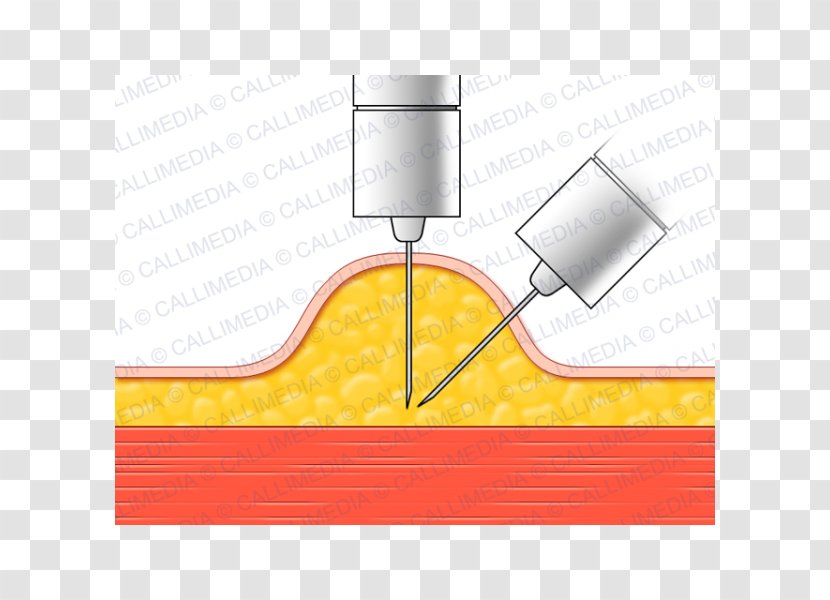 Subcutaneous Injection Endocrinology Diabetes Mellitus Diabetology - Yellow Transparent PNG