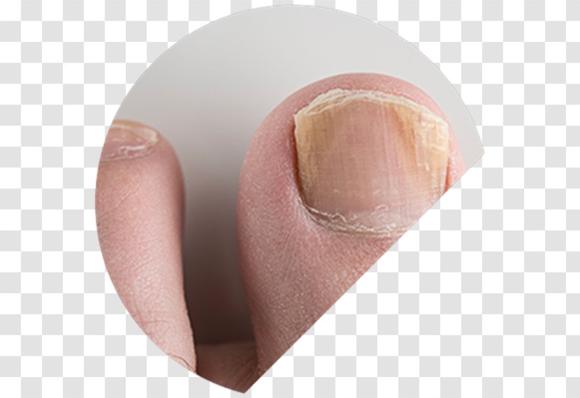 Onychomycosis The Nail Fungal Infection - Heart - Fingernail Foot Transparent PNG