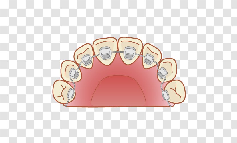 矯正歯科 Dental Braces Dentist 舌側矯正 - Tree - Orthodontics Transparent PNG