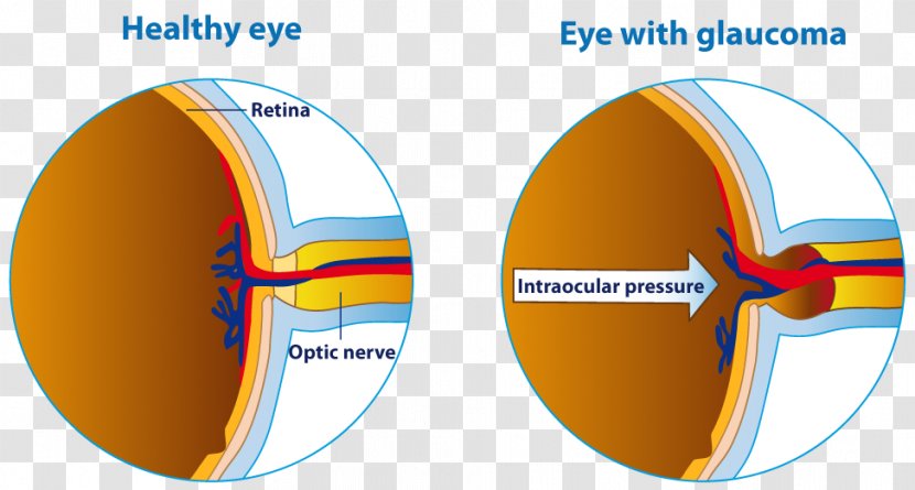Human Eye Glaucoma Care Professional Optic Nerve Transparent PNG