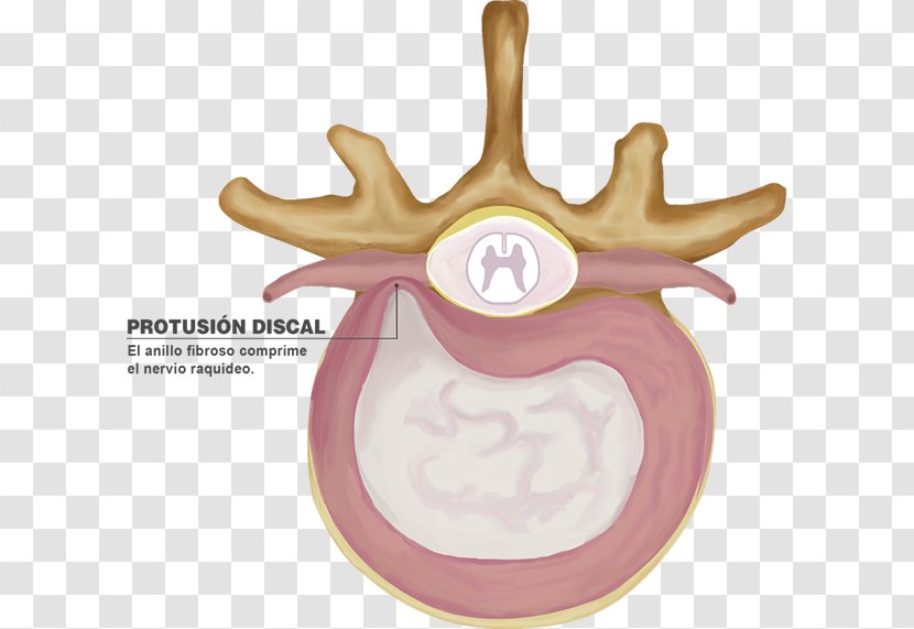 Intervertebral Disc Spinal Herniation Lumbar Vertebrae Protrusion - Heart - Columna Vertebral Transparent PNG