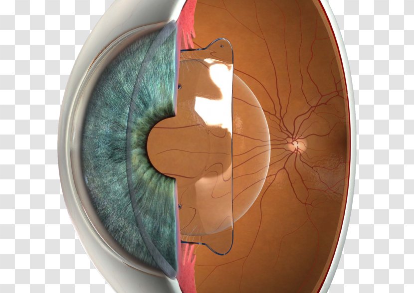 Phakic Intraocular Lens Implantable Collamer LASIK Visual Perception - Cartoon - Eye Transparent PNG