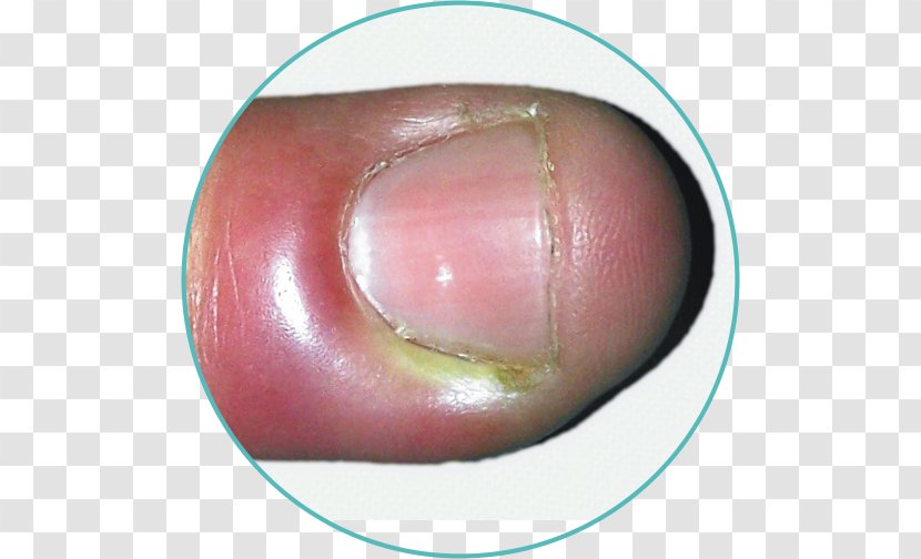 Nail Paronychia Inflammation Folliculitis Infection - Bacteria Transparent PNG