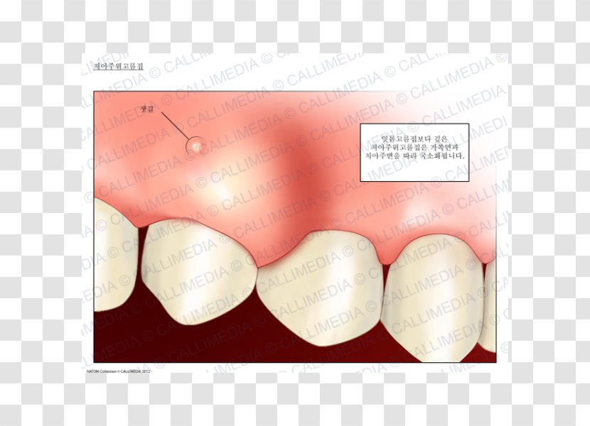 Dental Abscess Periodontal Gums Tooth - Frame - Human Respiratory System Transparent PNG